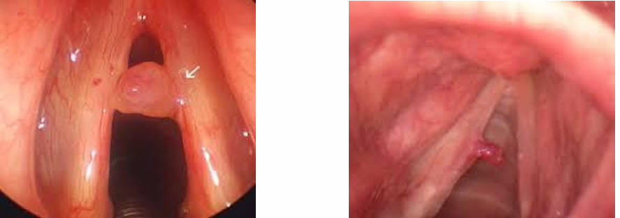 Celia_Logo's tweet photo. ¿Qué son los pólipos vocales?🧠🔎
Son lesiones benignas (no cancerosas) que aparecen en las cuerdas vocales debido a irritación o uso excesivo de la voz. Suelen ser más grandes y blandos que los nódulos vocales, y pueden contener líquido.
#uv_rtl25 https://t.co/LvYem4g3Qz