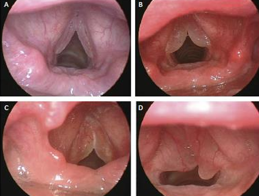 Celia_Logo's tweet photo. EDEMA DE REINKE🔎
Es un engrosamiento/tumefacción/edema que afecta a toda la extensión de la cuerda  vocal, por presencia de un material inflamatorio/fluido/gelatinoso en el espacio de Reinke  (debajo del epitelio de la cuerda vocal). Afecta a las DOS cuerdas
#uv_rtl25 https://t.co/ea0juAZAM1