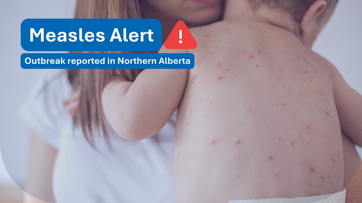 ⚠️ A #measlesoutbreak has been reported in northern Alberta. Measles is highly contagious, and early detection is crucial. If you have symptoms, stay home and call Health Link at 811 before visiting any healthcare facility. Learn more at myhealthalberta.ca