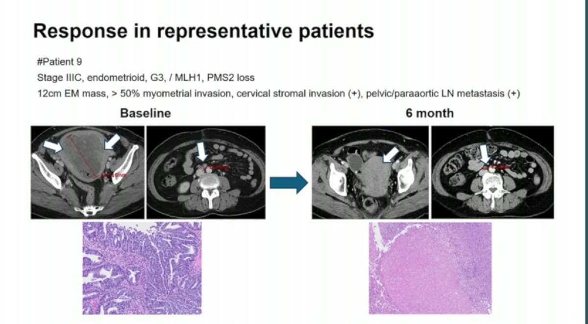 ShannonWestin's tweet photo. Intriguing data for neoadjuvant #immunotherapy in resectable MMRd #endometrialcancer - high pathologic response rate but be careful of small n!!!

Looking forward to C93 (pembrolizumab) and Domenica (dostarlimab) study results in advanced and recurrent disease 
#SGOMtg #gyncam https://t.co/6TED9UfatA
