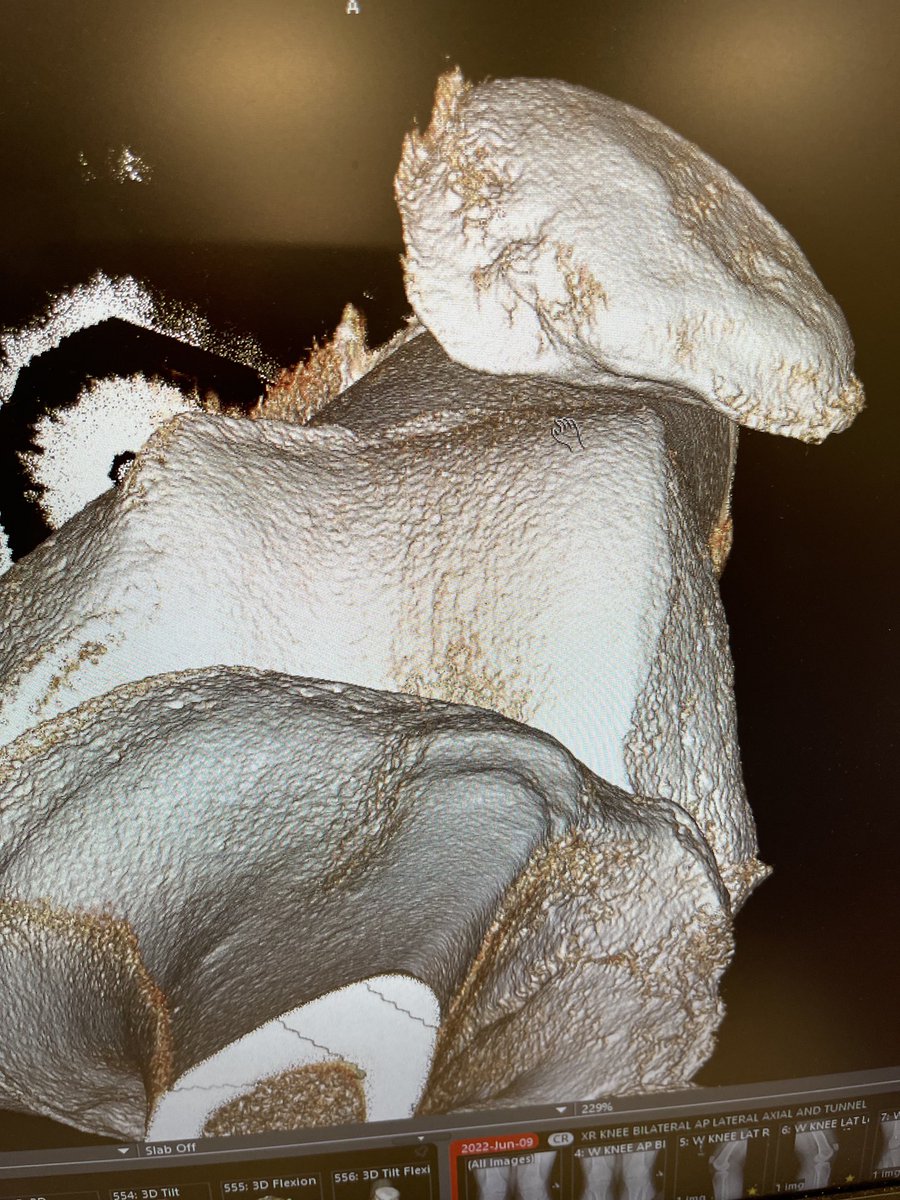 Move it to the groove. Joint preservation stabilization