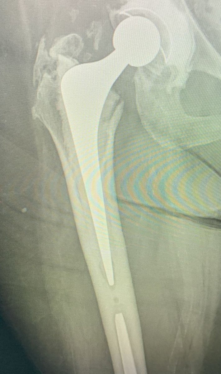 Does this X-ray intrigue you? Stemmed TKR with a THR above. Would you prophylactically plate the femur? We’d be grateful if you could fill in this survey to assess current practice <a href="/CavendishHip/">Cavendish Arthroplasty Fellowship</a>
<a href="/M_Sharrock9/">Martin Sharrock</a>
docs.google.com/forms/d/e/1FAI…