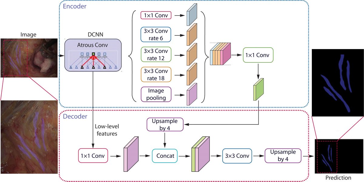 DCRjournal (@dcrjournal) on Twitter photo AI recognition system to identify pelvic autonomic nerves during TME. How? Read this fascinating paper in #DCRJournal: bit.ly/3F3BNpI
<a href="/SoniaRamMD/">Sonia Ramamoorthy, MD FACS FASCRS</a> <a href="/justinmaykel/">Justin Maykel</a> <a href="/changtangMD/">Melissa I. Chang | εΌ΅ζζ MD, FACS, FASCRS</a> <a href="/luciacolorectal/">Lucia Oliveira,MD,PhD</a> <a href="/deanlute/">Dean Lutrin</a> <a href="/juliomayol/">Julio Mayol</a> <a href="/drjamestaylor/">James Taylor</a> <a href="/KarasJoshua/">Joshua R Karas MD</a> <a href="/MaloneyNell/">Nell Maloney Patel</a> <a href="/Averywalker21/">Avery Walker, MD, FACS, FASCRS</a> AI recognition system to identify pelvic autonomic nerves during TME. How? Read this fascinating paper in #DCRJournal: bit.ly/3F3BNpI
<a href="/SoniaRamMD/">Sonia Ramamoorthy, MD FACS FASCRS</a> <a href="/justinmaykel/">Justin Maykel</a> <a href="/changtangMD/">Melissa I. Chang | εΌ΅ζζ MD, FACS, FASCRS</a> <a href="/luciacolorectal/">Lucia Oliveira,MD,PhD</a> <a href="/deanlute/">Dean Lutrin</a> <a href="/juliomayol/">Julio Mayol</a> <a href="/drjamestaylor/">James Taylor</a> <a href="/KarasJoshua/">Joshua R Karas MD</a> <a href="/MaloneyNell/">Nell Maloney Patel</a> <a href="/Averywalker21/">Avery Walker, MD, FACS, FASCRS</a>