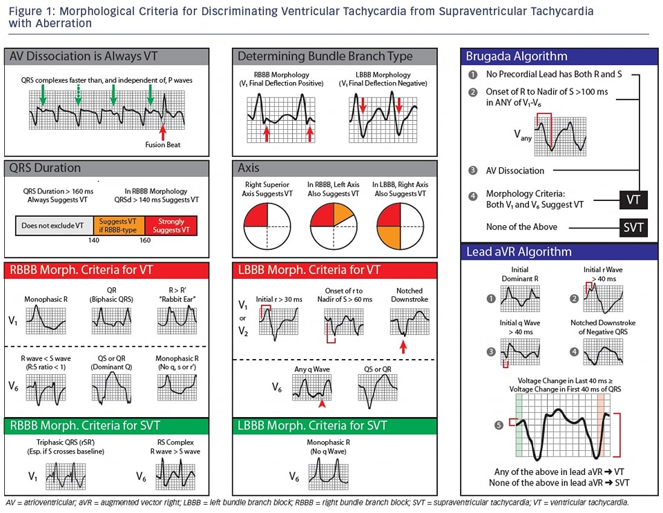 🔴Morphological Criteria for Discriminating VT from SVT with Aberration ⤵️ 

🔹radcliffecardiology.com/image-gallery/…
#Cardiology #medical #CVD #MedEd #medtwitter #CardioEd #CardioTwitter #medicinestudent #CardioEd #medicinestudent #CardioTwitter #cardiology #medical #meded #medicine