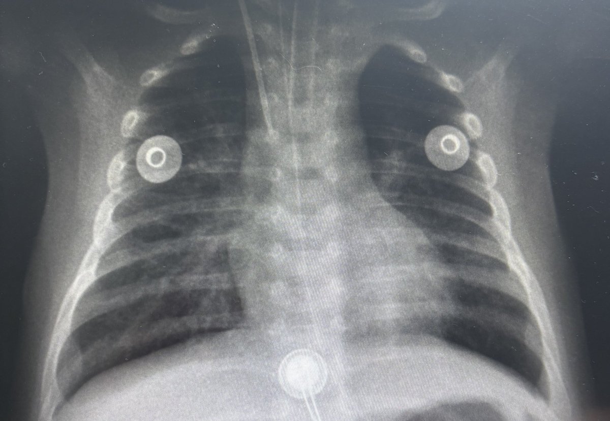 Yurvin_n's tweet image. Hoy puse mi primer Catéter Venoso Central en un bebé de 5meses 💪🏾🫶🏾🍀