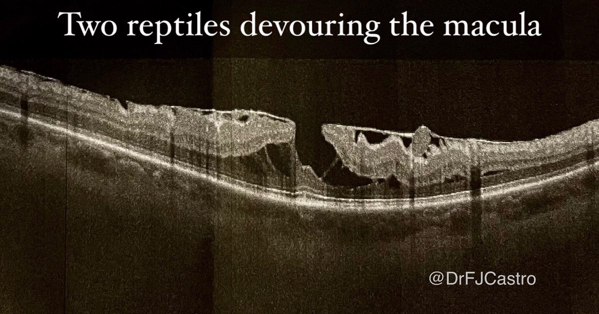 Can you imagine it? “Two reptiles devouring the macula”

Eres capaz de imaginártelo? “Dos reptiles devorando la mácula”

#oct #macula #ophthalmology #oftalmologo #drfjcastro