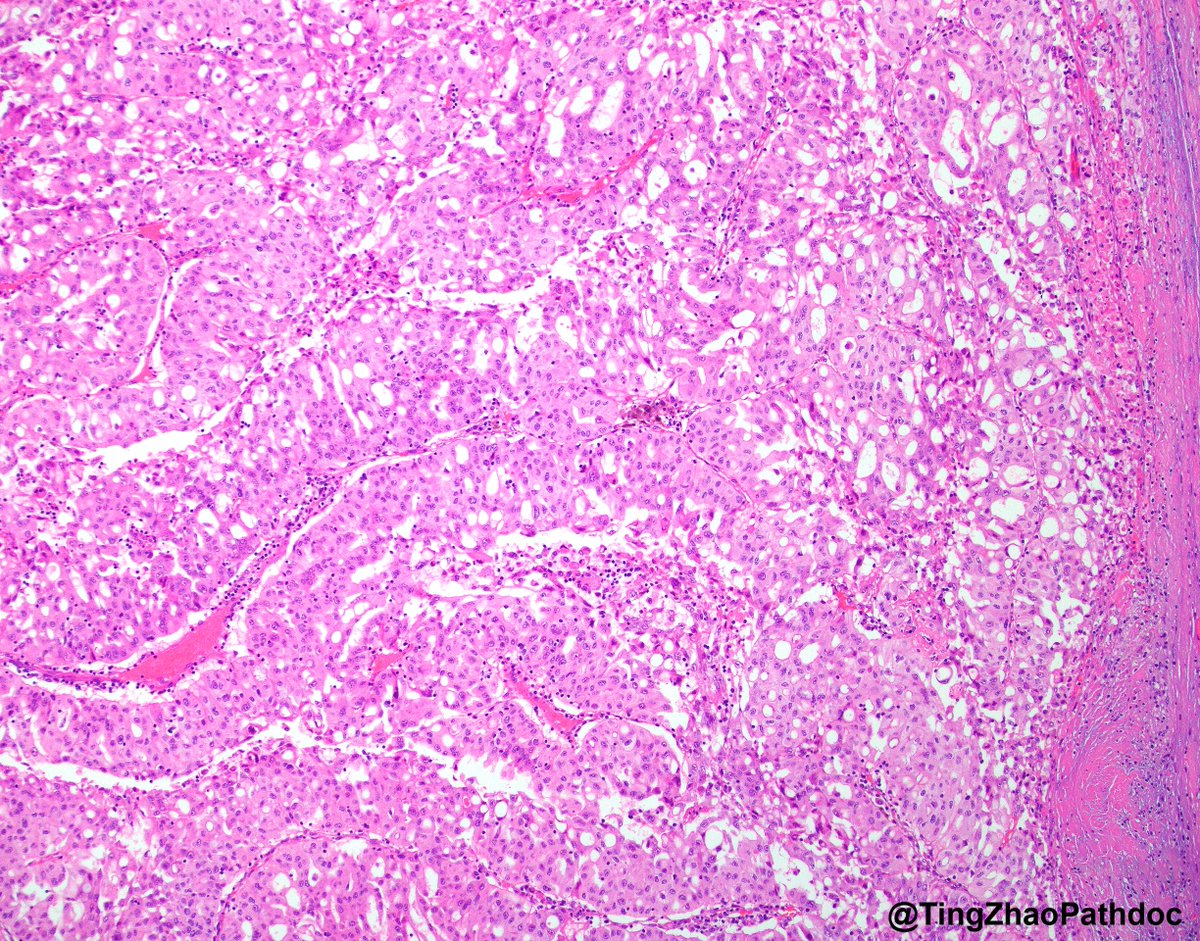 71 y.o. F. What is your diagnosis? More photos in chat.
#PathTwitter  <a href="/MGBpathology/">Mass General Brigham Pathology</a>  <a href="/MGHPathology/">MGH Pathology</a>