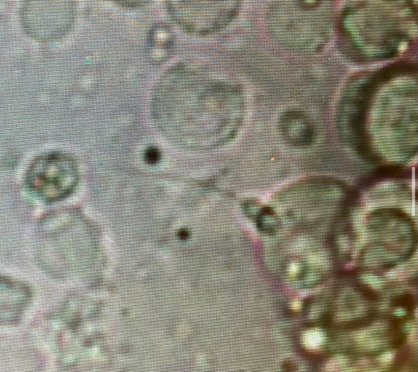 garyb7805's tweet image. Successfully retrieved testicular sperm (in good numbers) in a complex case for IVF today. Some sperm appeared European and even had berets in the pictures - one hatless and one stylishly sporting a beret. #IVF #SpermRetrieval  #Berets