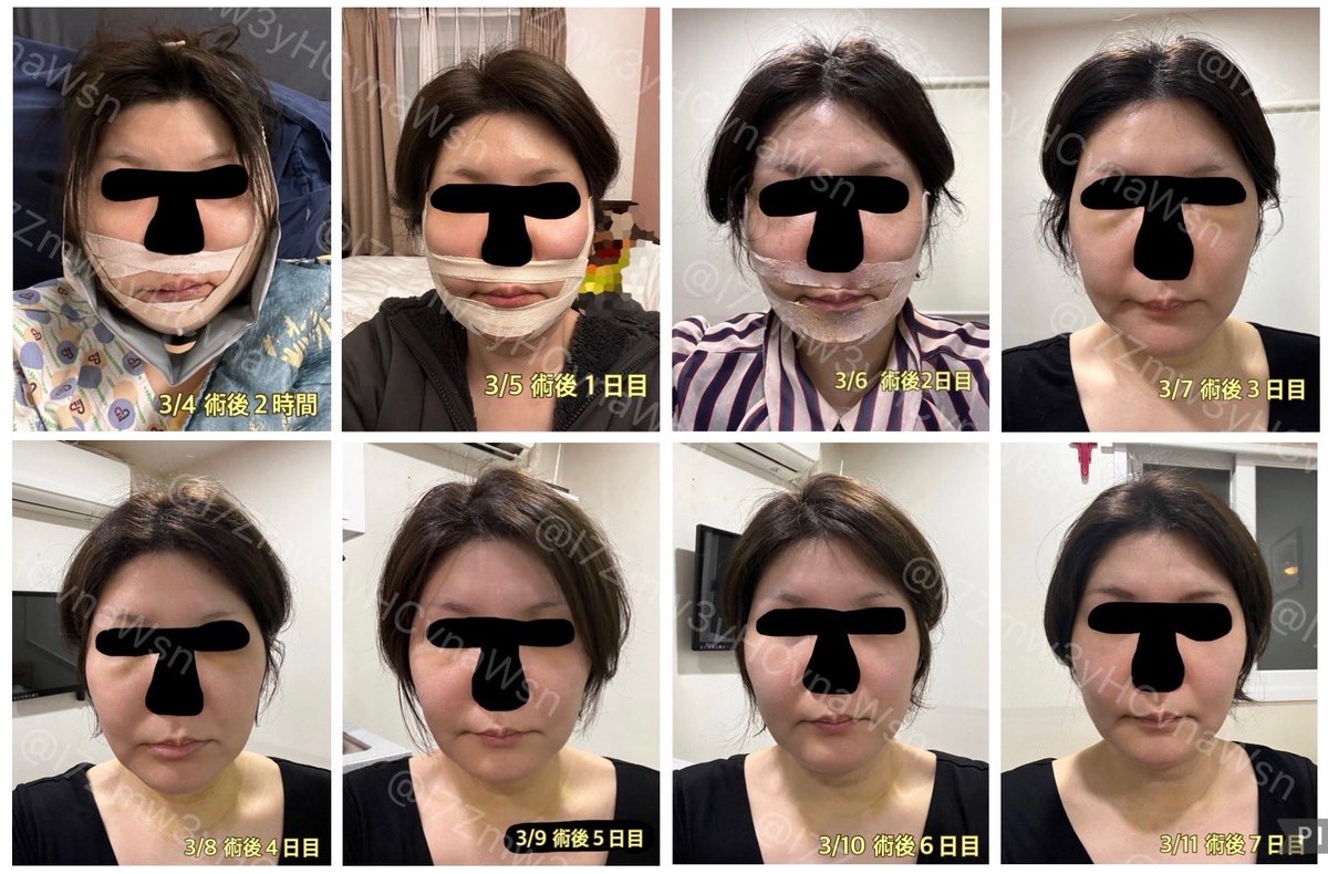 I7Zmw3yHCvnaWsn's tweet image. ソウルトック(@SEOULTUK)さんで受けた輪郭2.5点(頬骨+ミニV)の１週間の経過です！
テープの汚れ、個人が特定しやすい特徴(ほくろ等)は加工していますが、基本無修正＆ノーメイク、iPhoneノーマルカメラで撮影しています。

術後７日目に撮った🩻を見て頂くと、腫れが顕著！伸び代ありすぎ！！✨😂✨