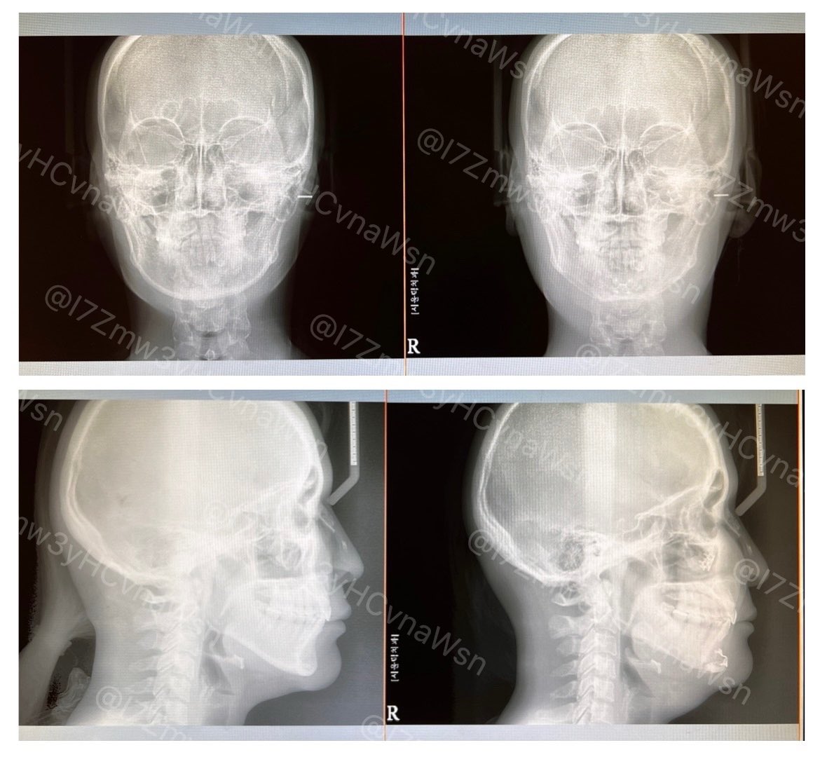 I7Zmw3yHCvnaWsn's tweet image. ソウルトック(@SEOULTUK)さんで受けた輪郭2.5点(頬骨+ミニV)の１週間の経過です！
テープの汚れ、個人が特定しやすい特徴(ほくろ等)は加工していますが、基本無修正＆ノーメイク、iPhoneノーマルカメラで撮影しています。

術後７日目に撮った🩻を見て頂くと、腫れが顕著！伸び代ありすぎ！！✨😂✨