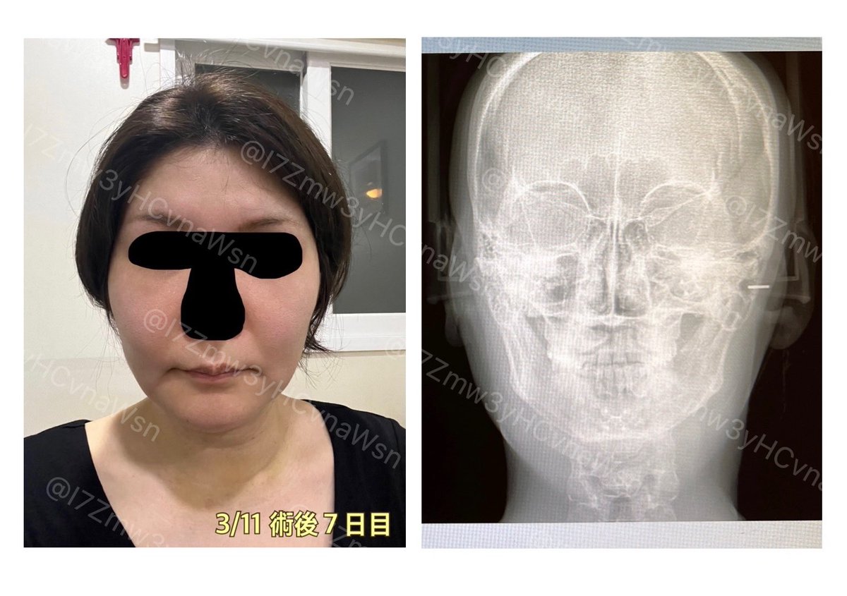I7Zmw3yHCvnaWsn's tweet image. ソウルトック(@SEOULTUK)さんで受けた輪郭2.5点(頬骨+ミニV)の１週間の経過です！
テープの汚れ、個人が特定しやすい特徴(ほくろ等)は加工していますが、基本無修正＆ノーメイク、iPhoneノーマルカメラで撮影しています。

術後７日目に撮った🩻を見て頂くと、腫れが顕著！伸び代ありすぎ！！✨😂✨