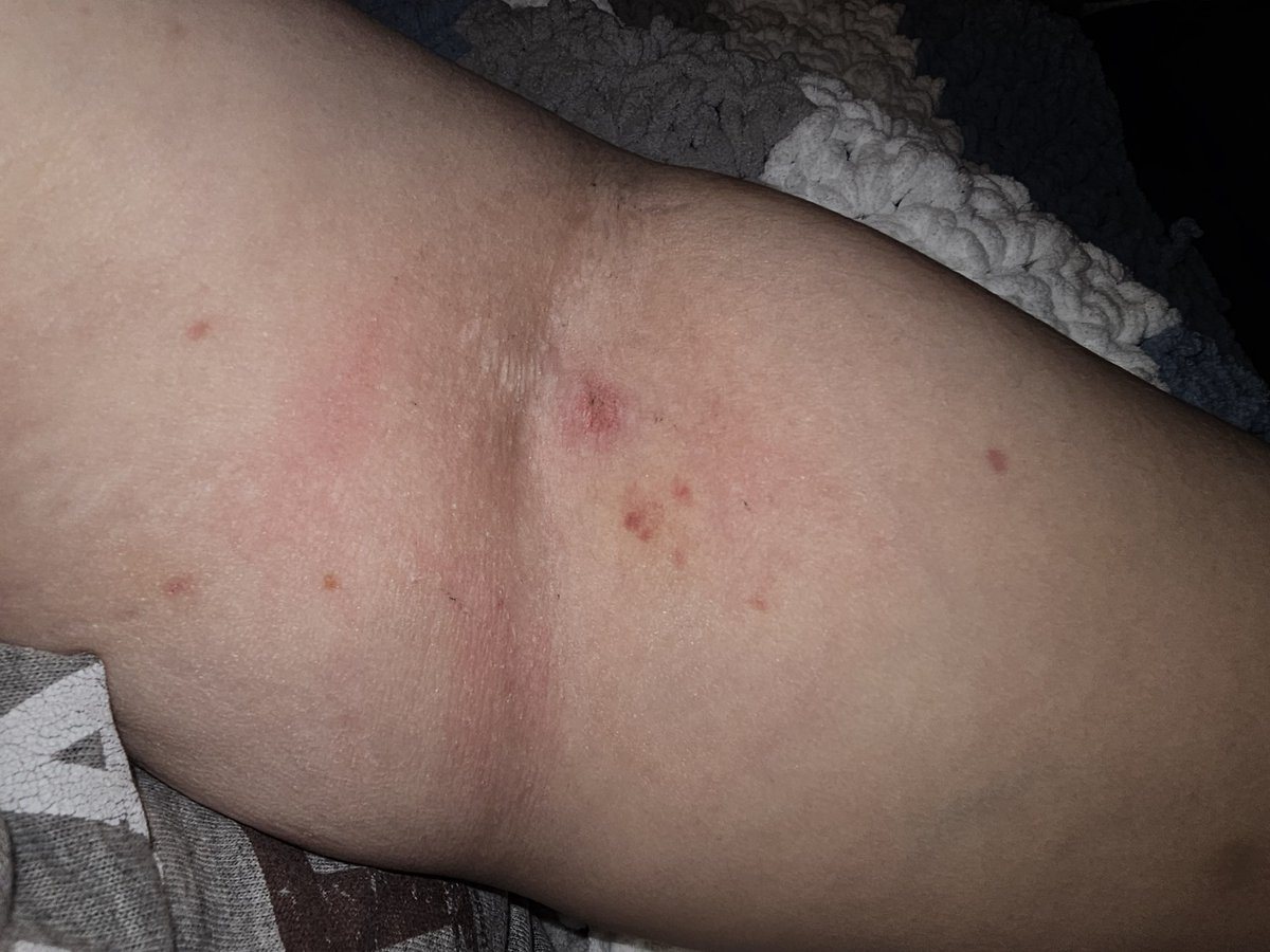 Sorry I was just released from the hospital. I went in with what I thought was a bad case of the stomach flu, ended up with two units of blood a CT scan and a whole bunch of other stuff. I am feeling so much better now but so tired! I look like a pin cushion!