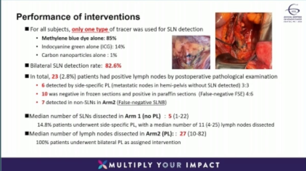 Omitting full pelvic lymphadenectomy did not negatively impact survival in early stage #cervicalcancer 

🤨Unclear why there was higher recurrence in the pelvic LND group vs pts that underwent sentinel lymph node biopsy #SGOMtg #gyncsm #SGO2025