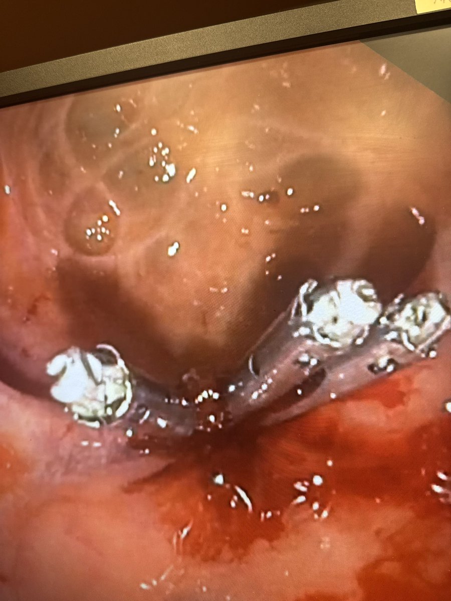 Christopher Marshall, MD (@colondocummh) on Twitter photo Periampullary diverticular bleeding treated with clipping using a side viewing endoscope. <a href="/UMassGI/">University of Massachusetts GI Fellowship</a> #gitwitter Periampullary diverticular bleeding treated with clipping using a side viewing endoscope. <a href="/UMassGI/">University of Massachusetts GI Fellowship</a> #gitwitter