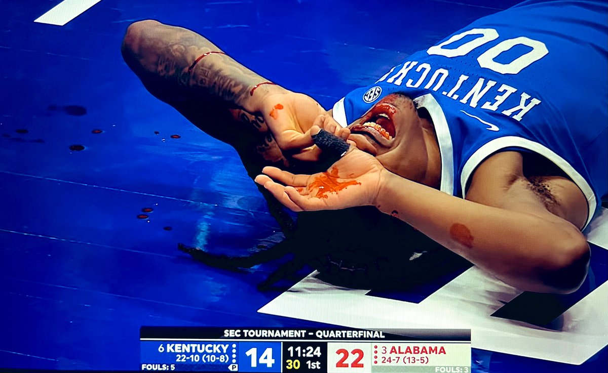 BigBlueBud's tweet image. Face shattered: foul on Oweh. Naturally. #BBN