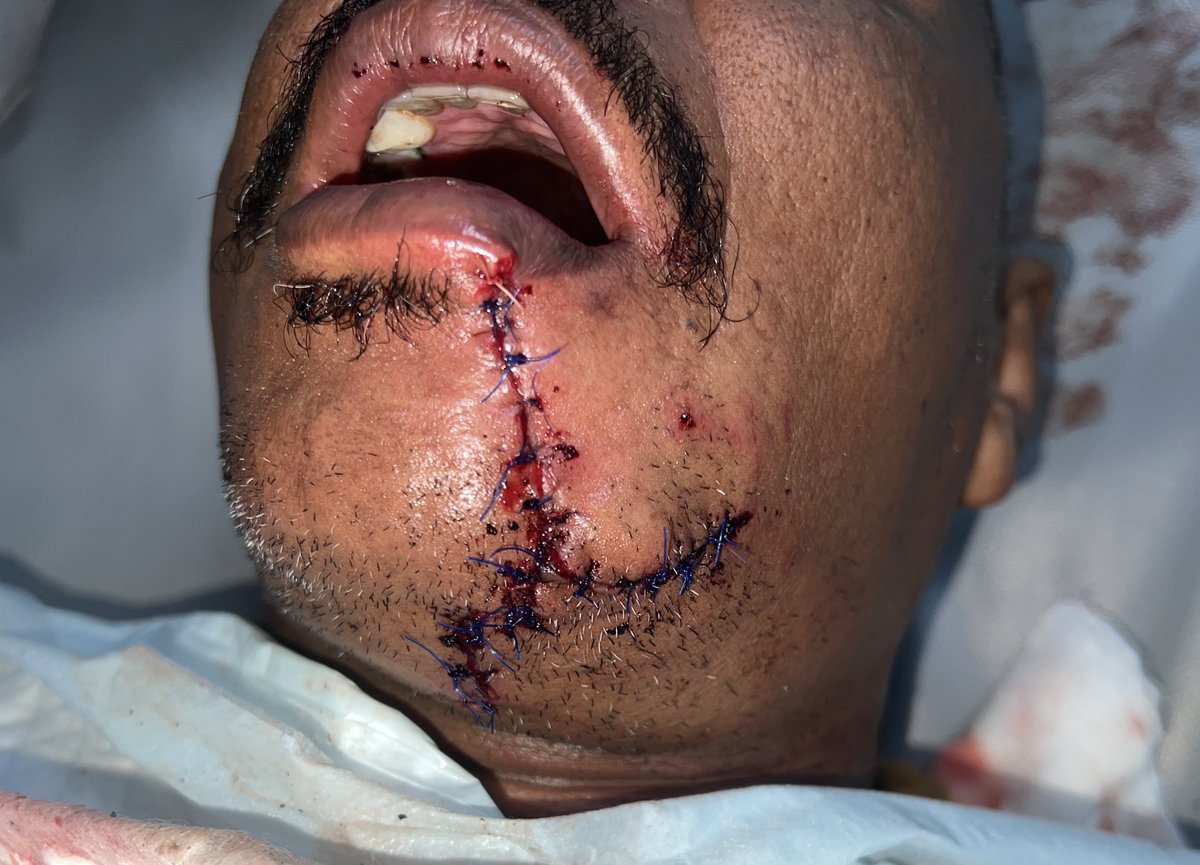 Management of through and through laceration for motorcycle RTA case