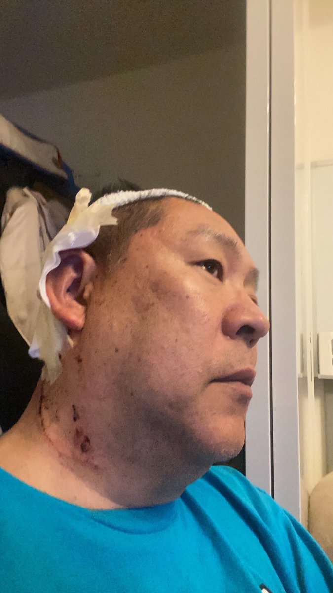 耳と、頭皮は、縫ってもらいました。
【ガーゼで見えない部分】
首の傷は深くないので、縫ってません。
【写真に写っている傷】
犯人は、首を狙ったのだと思います。

この傷をみて、自作自演って言ってる人は、説明しても無駄な人なので、相手しなくて良いと思います。