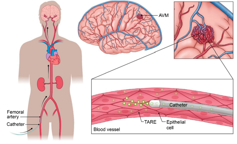 Ali Mortezaei (@alimortezaei97) on Twitter photo 📢Hot off press <a href="/NRADjournal/">Neuroradiology</a>!
Microsphere Embolization – A Game-Changer?
Our latest study explores ATME for AVM treatment, highlighting efficacy, safety, and outcomes.
Special thanks to <a href="/SheriefGhozy/">Sherief Ghozy, MD</a> <a href="/AmirHFaraji/">Amir Faraji, MD, PhD</a> <a href="/AlexHoangMD/">Alex Hoang</a>
<a href="/KTaghlabi/">Khaled M. Taghlabi, MD</a> <a href="/MCNeurovasc/">Mayo Clinic Neurovascular</a>.
Link:link.springer.com/article/10.100… 📢Hot off press <a href="/NRADjournal/">Neuroradiology</a>!
Microsphere Embolization – A Game-Changer?
Our latest study explores ATME for AVM treatment, highlighting efficacy, safety, and outcomes.
Special thanks to <a href="/SheriefGhozy/">Sherief Ghozy, MD</a> <a href="/AmirHFaraji/">Amir Faraji, MD, PhD</a> <a href="/AlexHoangMD/">Alex Hoang</a>
<a href="/KTaghlabi/">Khaled M. Taghlabi, MD</a> <a href="/MCNeurovasc/">Mayo Clinic Neurovascular</a>.
Link:link.springer.com/article/10.100…