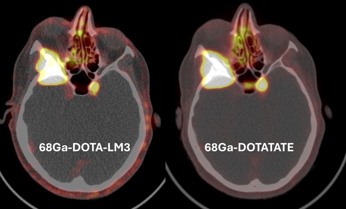 68Ga-DOTA-LM3 PET/CT: A Somatostatin Receptor Antagonist in a Patient with Progressive Meningioma. Exploring new imaging approaches for better tumor characterization and management. #SSTR_Antagonist #NeuroOncology #PETCT #Meningioma