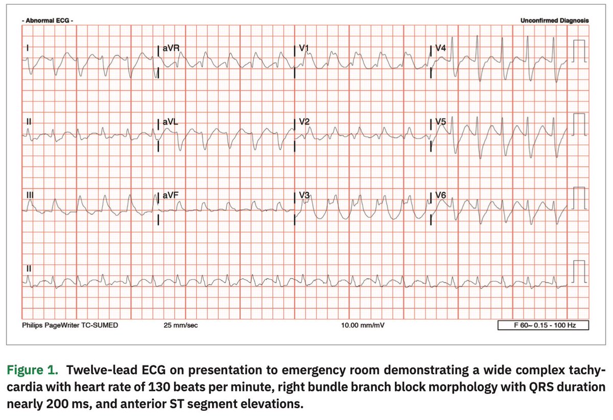Basalus's tweet photo. 🚨 Flecainide Overdose: A Deadly Disruptor 🚨

Flecainide is a powerful antiarrhythmic, but in overdose, it can wreak havoc on the heart and nervous system. Here’s what to look out for and how to manage it. 🧵⬇️ https://t.co/PpJtYOaqhe