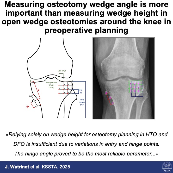 Precision in osteotomy planning: The Wedge angle remains stable, but wedge height varies with entry and hinge points—highlighting the need for intraoperative depth adjustments to ensure accurate limb alignment.
Reach here: doi.org/10.1002/ksa.12…