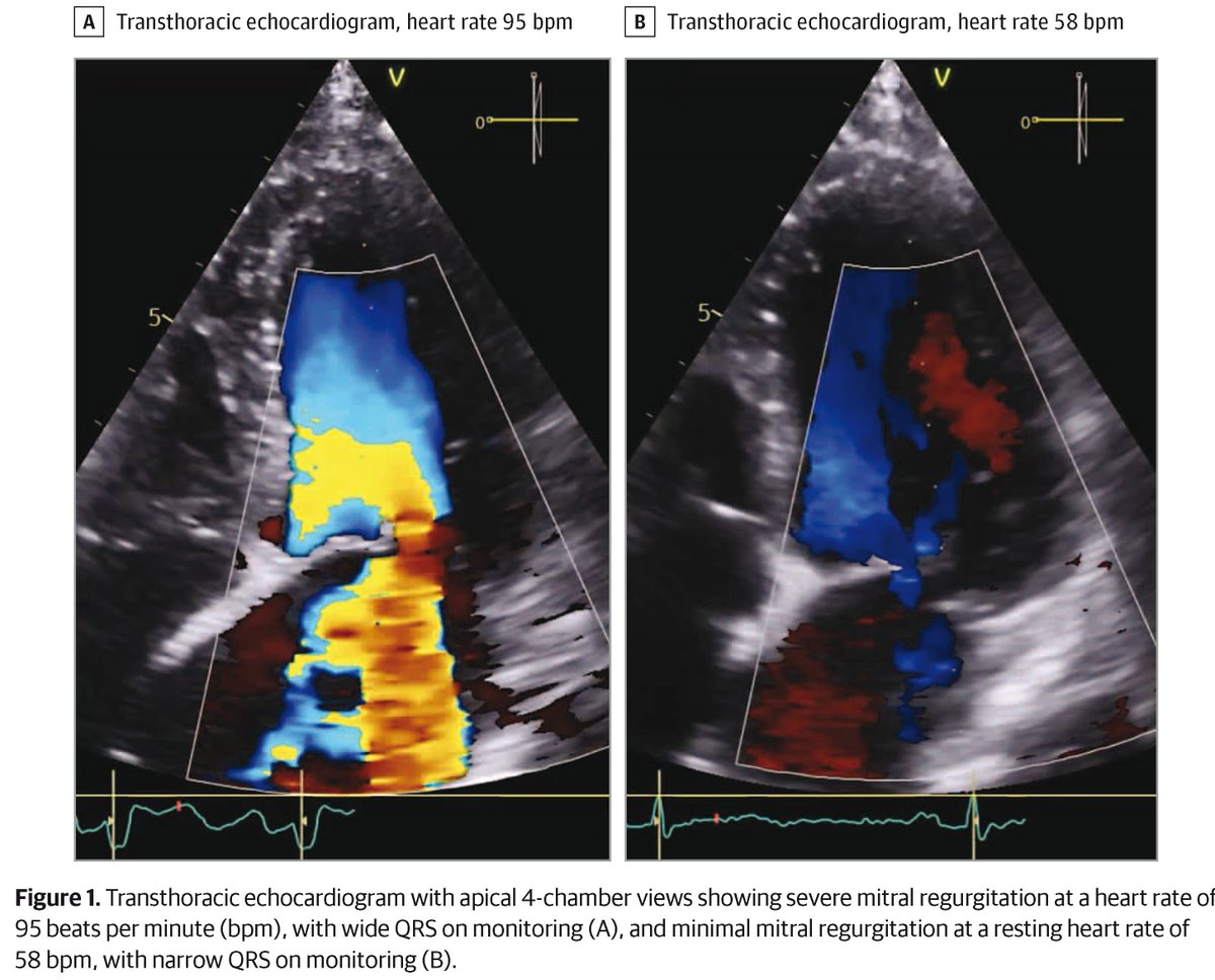 JAMA Cardiology (@jamacardio) on Twitter photo An older woman w a history of coronary artery disease presents w dyspnea upon exertion. Transthoracic echocardiogram reveals severe mitral regurgitation, and an ECG reveals sinus tachycardia w left bundle branch block. What would you do next? ja.ma/4bwXtqs <a href="/GuenanciaC/">Charles Guenancia</a> An older woman w a history of coronary artery disease presents w dyspnea upon exertion. Transthoracic echocardiogram reveals severe mitral regurgitation, and an ECG reveals sinus tachycardia w left bundle branch block. What would you do next? ja.ma/4bwXtqs <a href="/GuenanciaC/">Charles Guenancia</a>