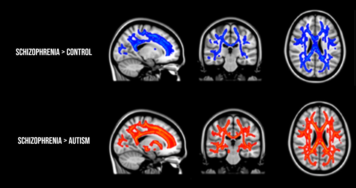 Schizophrenia may be on the autism spectrum.

🧵1/10