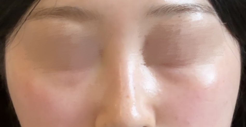tootaedayo's tweet photo. ずっとコンプレックスだったクマをリンク美容外科で目の下脂肪再配置してきました☆。.:＊・゜

執刀医はソンハミン院長でカウンセリングも丁寧で日本人通訳の方がいたので安心しました(⁎ᴗ͈ˬᴗ͈⁎)
当日から若干腫れと鈍痛がありますが1ヶ月後の経過が楽しみですჱ̒՞ ̳ᴗ ̫ ᴗ ̳՞꒱ https://t.co/LkwBO2CxQB