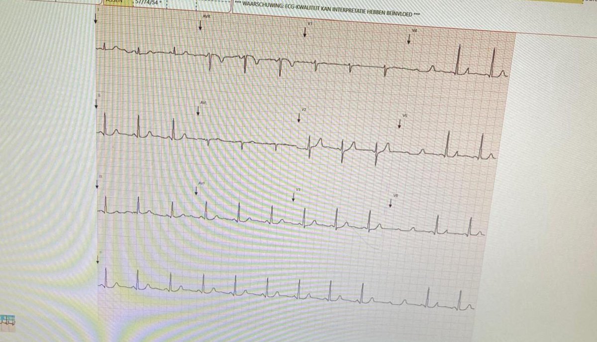The Curious Case of the Concealed QRS.