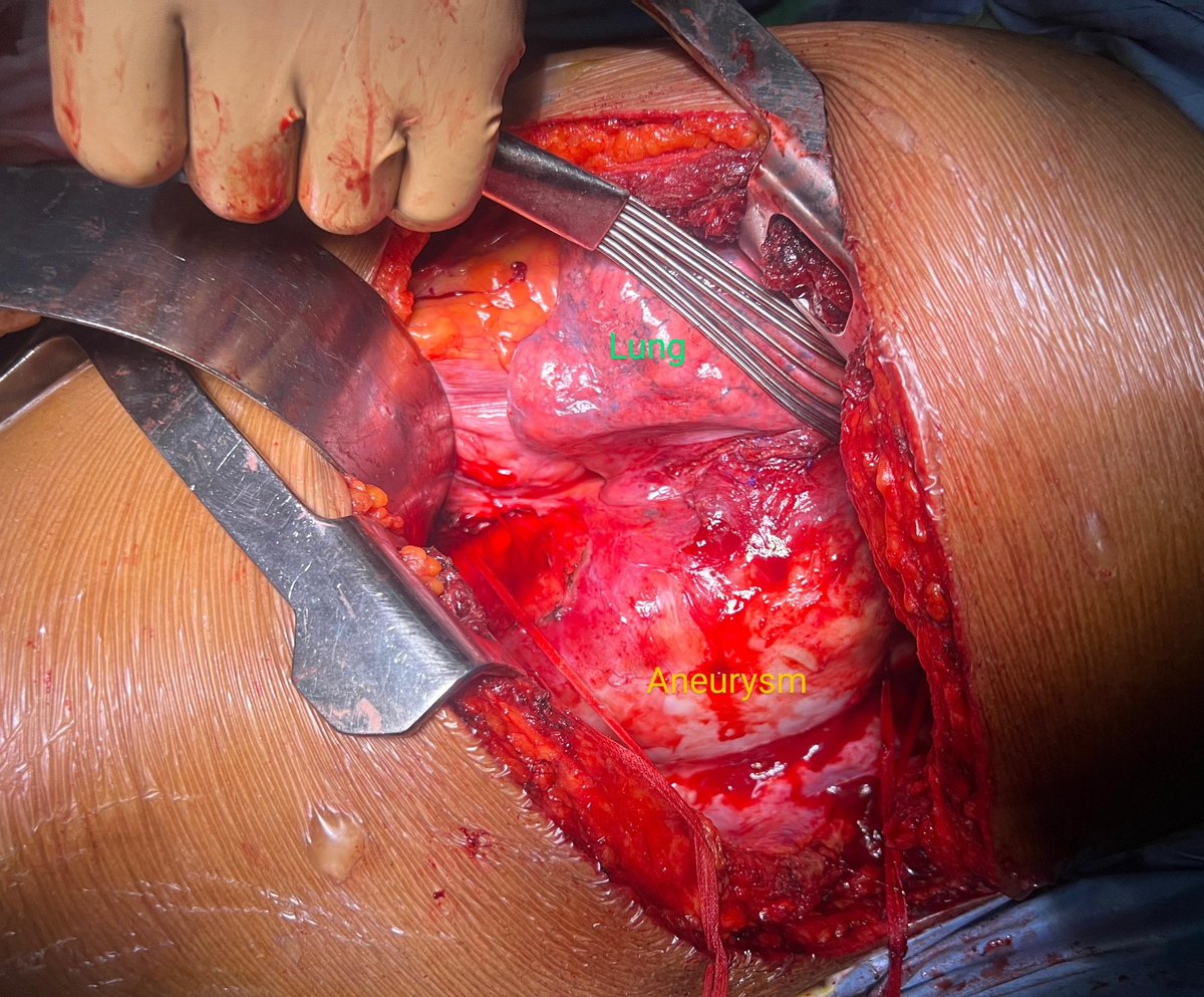 PrajnaKota's tweet image. 62 year old man,recently recovered Leptospirosis and AKI, found to have a new onset saccular DTA aneurysm, repaired with tubularized bovine pericardium,  debridement and omental cover. #tropicalaortas #aortaEd @PShivanesandr @sctimst_tvm 
#openit