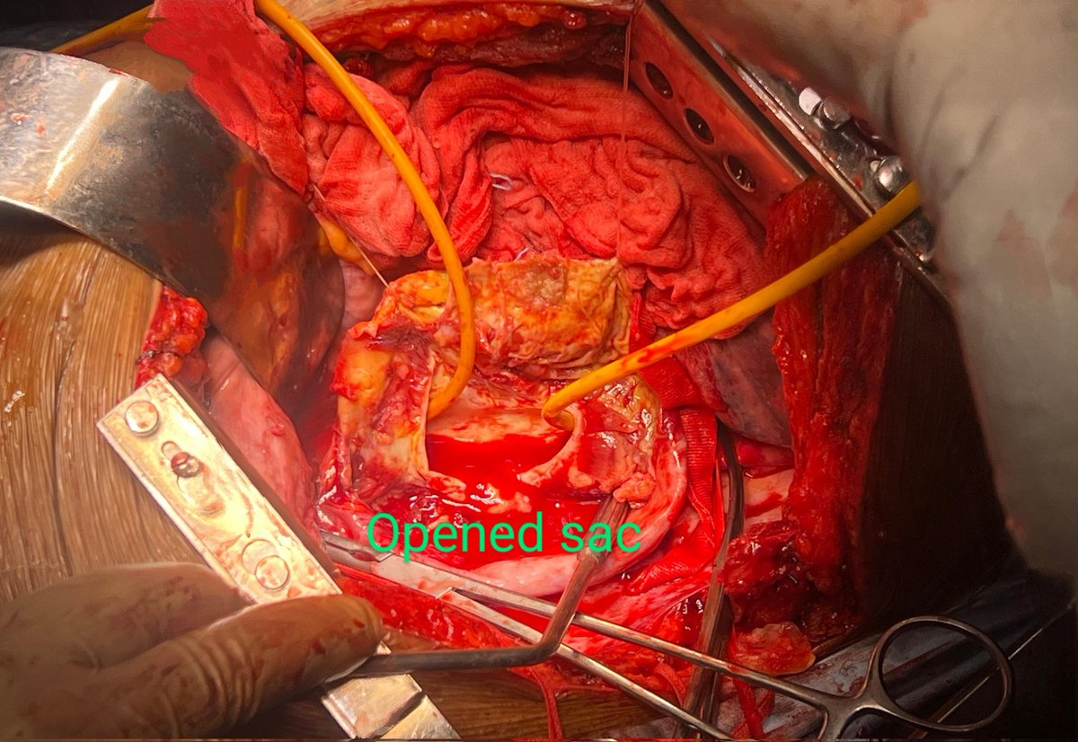 PrajnaKota's tweet image. 62 year old man,recently recovered Leptospirosis and AKI, found to have a new onset saccular DTA aneurysm, repaired with tubularized bovine pericardium,  debridement and omental cover. #tropicalaortas #aortaEd @PShivanesandr @sctimst_tvm 
#openit