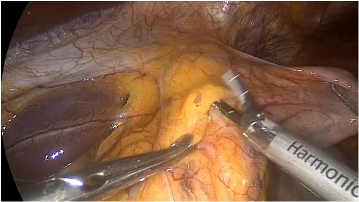 Surgery_First's tweet photo. 📌ЛАПАРОСКОПИЧЕСКАЯ ЭЗОФАГОКАРДИОМИОТОМИЯ ПРИ АХАЛАЗИИ КАРДИИ
-🎥ВИДЕО ОПЕРАЦИИ-
👉По��робнее на https://t.co/OWHvjGGm8q
#РНЦХимПетровского #ТАХиО_РНЦХ #лапароскопия #хирургия https://t.co/S2xhhfwOgf