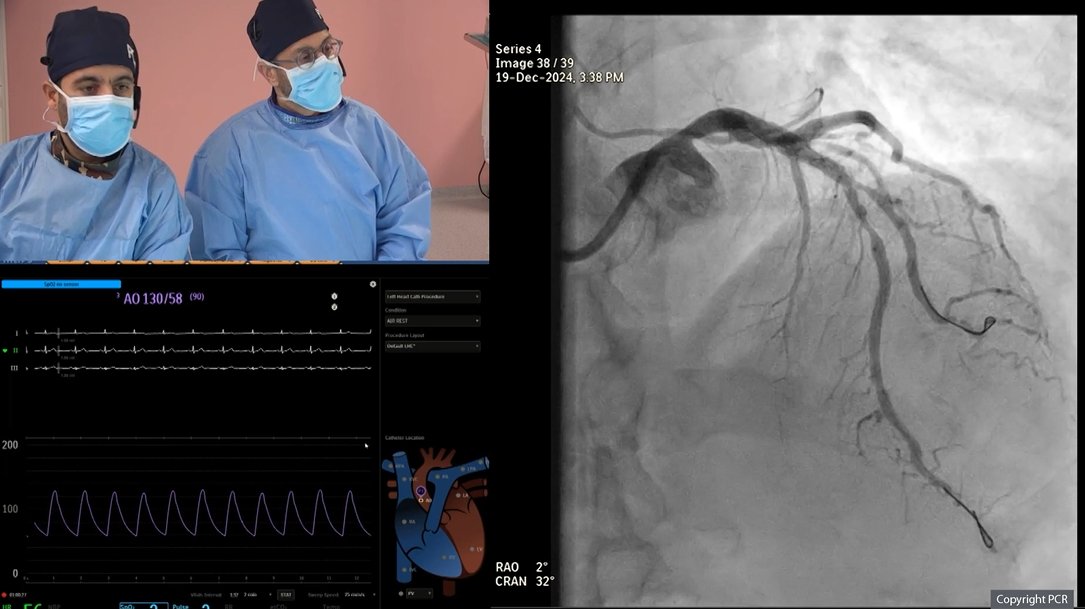 PCRonline 🫀 (@pcronline) on Twitter photo Two-stent strategy for non-LM #bifurcation: Culotte technique
Watch the replay of this LIVE Educational case with operators H. Al Lawati, K. Al Saidi and procedural analyst <a href="/ANazmiCalik/">A.Nazmi Calik</a>
📺pcronline.com/Cases-resource…
Key 🔑 moments
7:00-10:30 - Imaging analysis
24:37-30:30 - Two-stent strategy for non-LM #bifurcation: Culotte technique
Watch the replay of this LIVE Educational case with operators H. Al Lawati, K. Al Saidi and procedural analyst <a href="/ANazmiCalik/">A.Nazmi Calik</a>
📺pcronline.com/Cases-resource…
Key 🔑 moments
7:00-10:30 - Imaging analysis
24:37-30:30 -