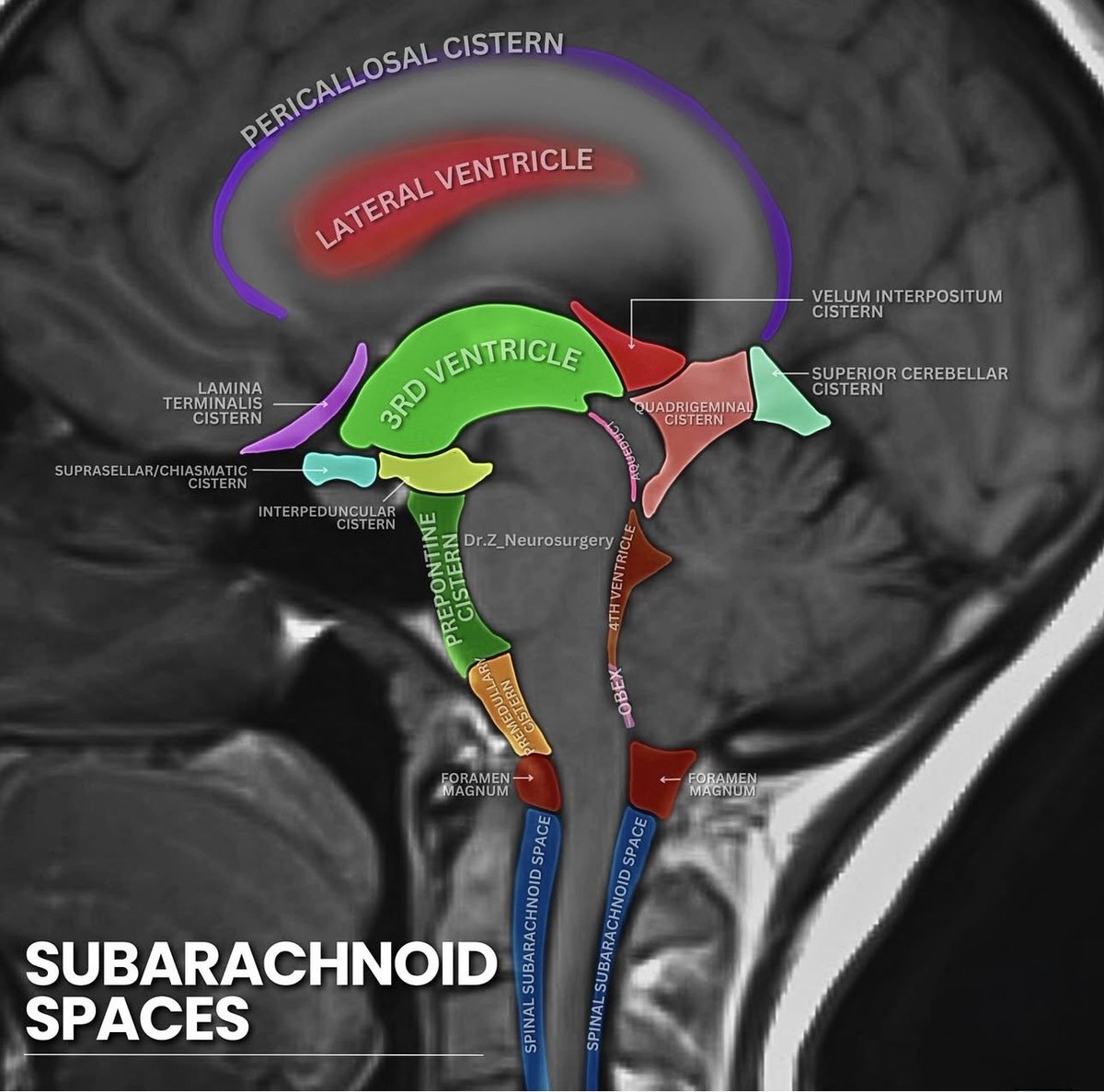 OGdukeneurosurg's tweet photo. BRAIN CISTERNS 
Cistern means water tank or reservoir. 
By Dr.z_neurosurgery https://t.co/odpjXgyECC