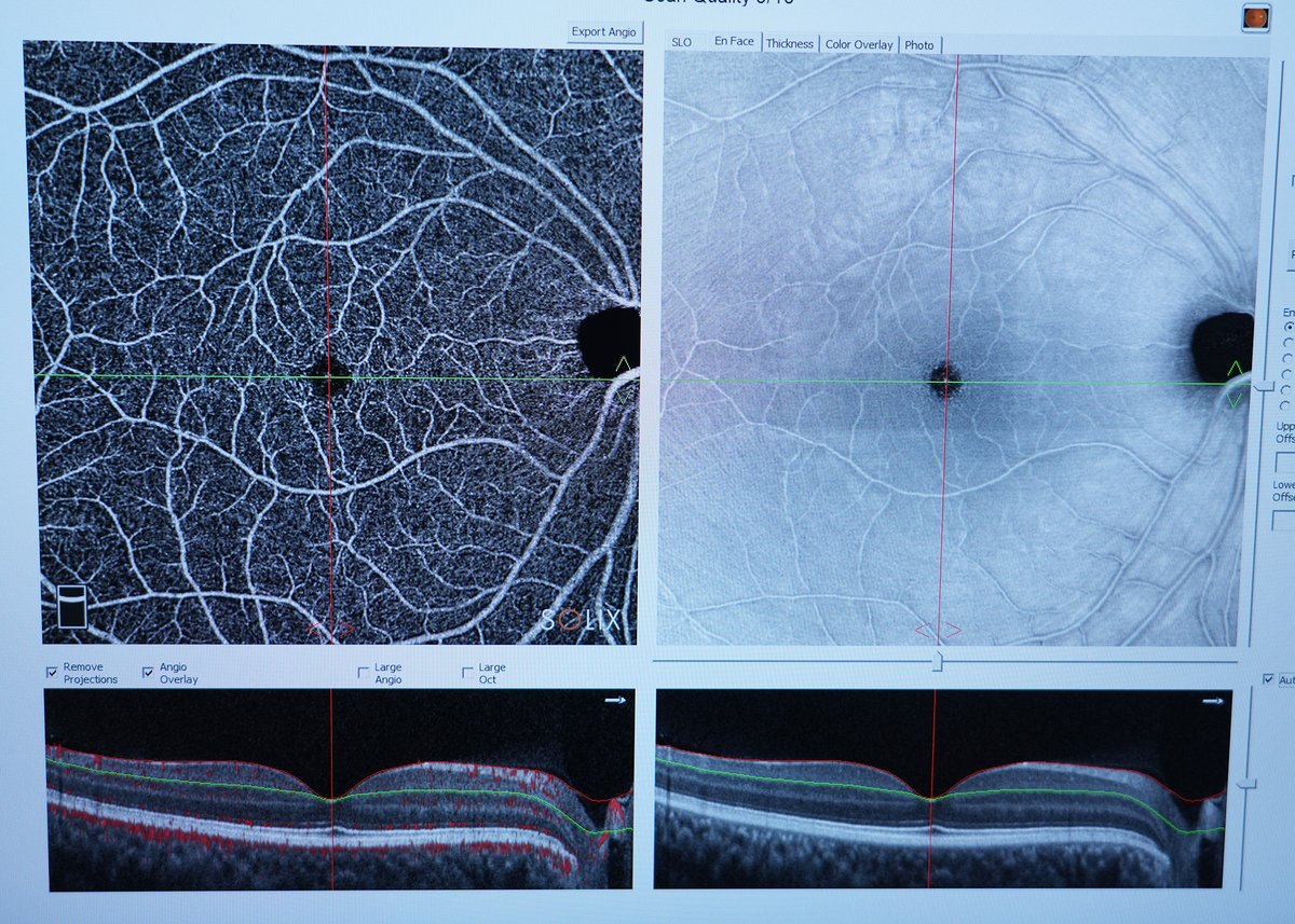 As scientists work to get to the bottom of long COVID, a recent study from the Northwestern Medicine Comprehensive COVID-19 Center shows that people with #LongCOVID19 have fewer blood vessels in the back of their eyes, which may be due to less blood circulation in the brain.