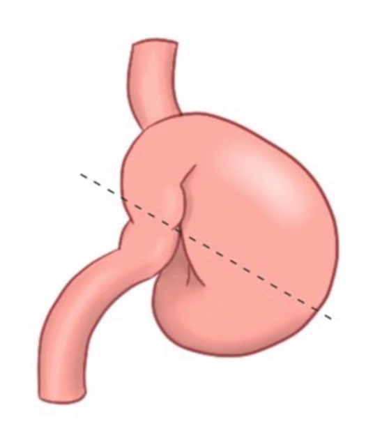 fadybanno's tweet photo. I performed an EGD on a patient and noted a possibly mesenteroaxial orientation of the stomach based on both the endoscopic findings and the way the scope behaved during the procedure. Navigating past the pylorus was particularly challenging. There’s something especially satisfying about challenging endoscopies.

It felt like performing a sliding maneuver in a sigmoid colon while the scope is looping. 

Has anyone had experience with this? Other than suctioning the stomach, what else can be done? #GI #GIX