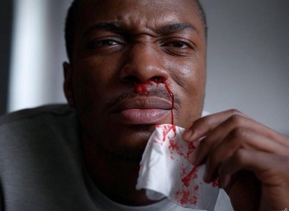 celebritypharm's tweet photo. NOSEBLEEDS 

Nosebleeds, also known as epistaxis, are one of those things we’ve either experienced or seen at some point. 

Even though they can look alarming, most of the time they’re harmless and easy to manage. 

Regardless, it’s worth knowing what causes them, how to handle them, and when to take them seriously.

Come with me 👇