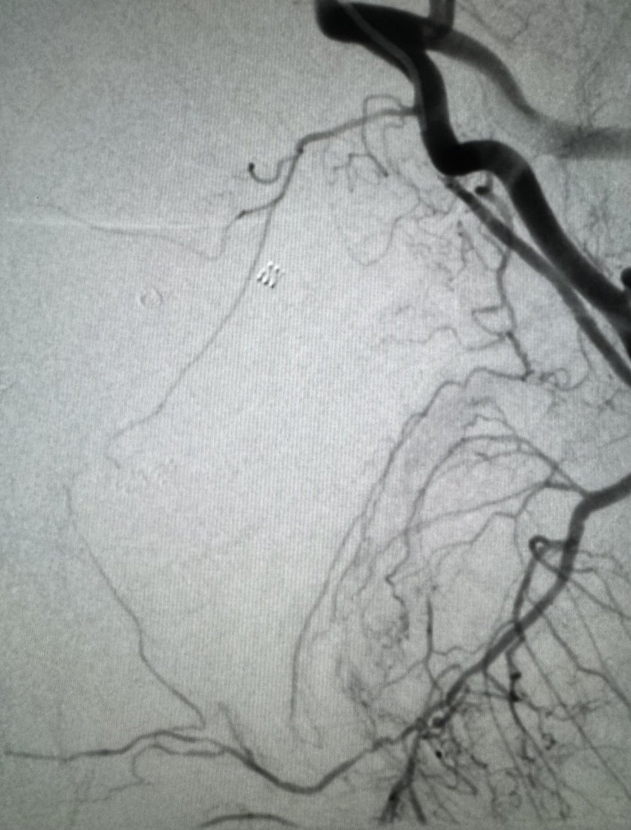 DrGluRu's tweet image. For #PAE, don’t forget about the corona mortise obturator artery! Yes, I also embolized the small pena cava from vesical/internal pudendal artery. #menshealth #prostate #BPH #irad @SIRspecialists @SIR_ECS @SIRRFS @MountSinaiIR