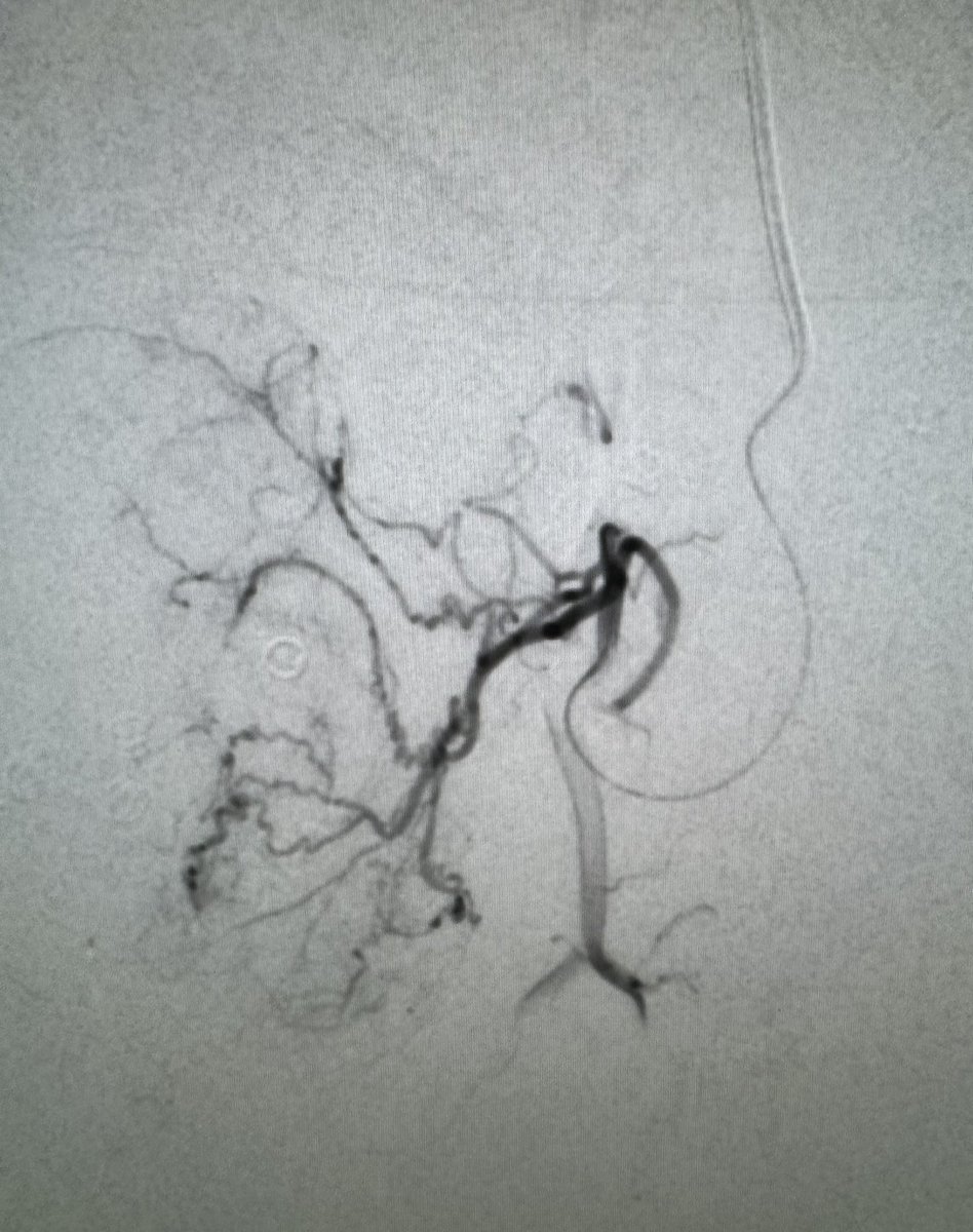 DrGluRu's tweet image. For #PAE, don’t forget about the corona mortise obturator artery! Yes, I also embolized the small pena cava from vesical/internal pudendal artery. #menshealth #prostate #BPH #irad @SIRspecialists @SIR_ECS @SIRRFS @MountSinaiIR