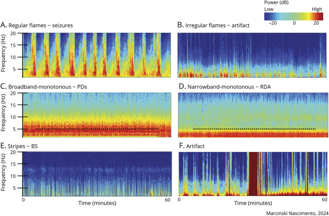 Fábio Nascimento (@fabnascimen) on Twitter photo Educators may use this infographic👇to teach and illustrate each of the 6 emblematic #EEG spectrogram patterns! <a href="/KNascimenski/">Kaley Marcinski Nascimento</a>
neurology.org/doi/10.1212/NE… Educators may use this infographic👇to teach and illustrate each of the 6 emblematic #EEG spectrogram patterns! <a href="/KNascimenski/">Kaley Marcinski Nascimento</a>
neurology.org/doi/10.1212/NE…