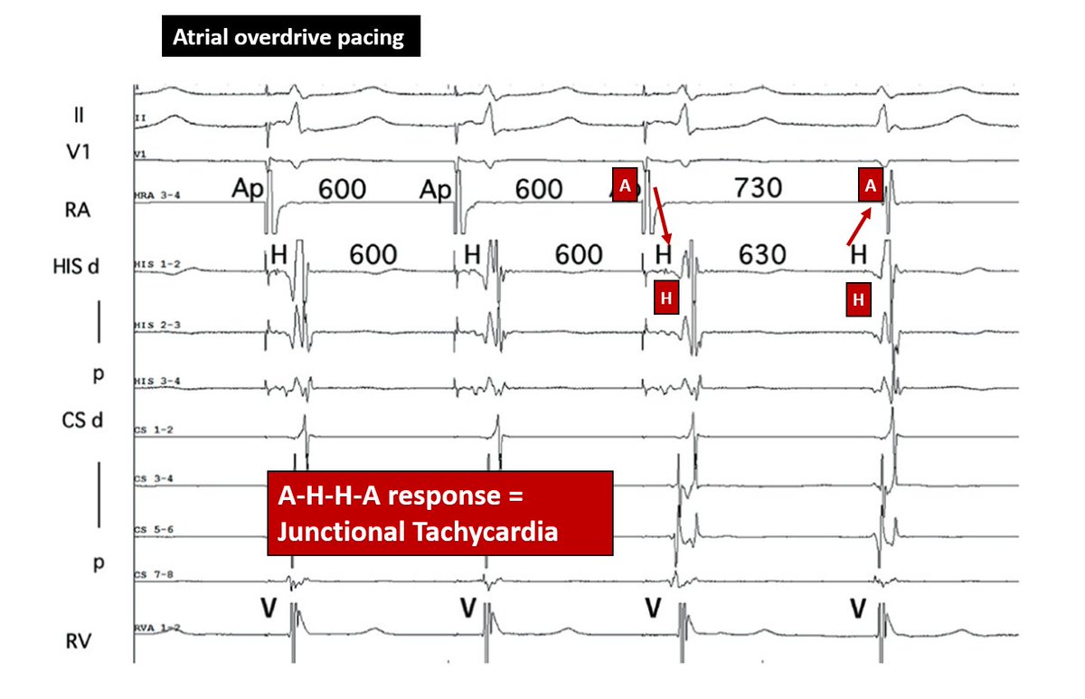 🧵Atrial Overdrive Pacing (AOP) is an under-utilized maneuver during SVT study! Here is a quick run👇

1/ AOP can help distinguishing AVNRT from Junctional tachycardia (specially helpful in A-on-V tachycardia):

👉A-H-H-A response: Junctional
👉A-H-A response: AVNRT

Example #1