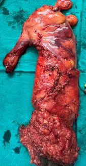 Peritoneal Surface Oncology Group International (@psogi_ec) on Twitter photo #PSOGICASE
CASE OF THE MONTH #37
Finally summarized here
wakelet.com/wake/_OPTNCiORā¦
With <a href="/PSugarbaker/">Paul H Sugarbaker</a> and <a href="/docswapnil01/">Swapnil Patel</a>
interesting inputs from <a href="/DrFloresAyala/">Guillermo</a> <a href="/drarturreis/">Artur Reis</a> <a href="/FarazKh65499316/">Faraz Khan</a>
Locally-advanced signet ring cell cancer of the rectum with incidentally detected #PSOGICASE
CASE OF THE MONTH #37
Finally summarized here
wakelet.com/wake/_OPTNCiORā¦
With <a href="/PSugarbaker/">Paul H Sugarbaker</a> and <a href="/docswapnil01/">Swapnil Patel</a>
interesting inputs from <a href="/DrFloresAyala/">Guillermo</a> <a href="/drarturreis/">Artur Reis</a> <a href="/FarazKh65499316/">Faraz Khan</a>
Locally-advanced signet ring cell cancer of the rectum with incidentally detected