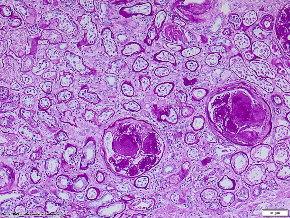 DraSabin's tweet image. Class IV: advanced diabetic glomerulosclerosis
&amp;gt; 50% globally sclerosed glomeruli and clinical correlation
-Diffuse thickening of glomerular BM 
- See hyalinosis of afferent and efferent arterioles
- Microaneurysms of glomerular capillaries
#diabetes #kidneypath #pathology
