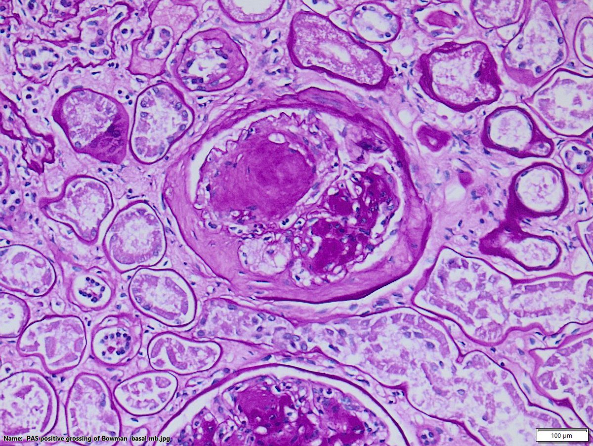 DraSabin's tweet image. Class IV: advanced diabetic glomerulosclerosis
&amp;gt; 50% globally sclerosed glomeruli and clinical correlation
-Diffuse thickening of glomerular BM 
- See hyalinosis of afferent and efferent arterioles
- Microaneurysms of glomerular capillaries
#diabetes #kidneypath #pathology