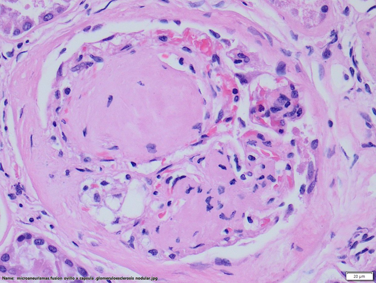 DraSabin's tweet image. Class IV: advanced diabetic glomerulosclerosis
&amp;gt; 50% globally sclerosed glomeruli and clinical correlation
-Diffuse thickening of glomerular BM 
- See hyalinosis of afferent and efferent arterioles
- Microaneurysms of glomerular capillaries
#diabetes #kidneypath #pathology