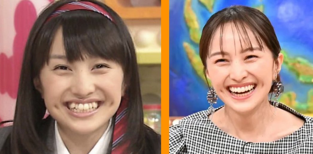 どう考えても豊胸より歯列矯正を1番にやるべき（笑）
歯並びが綺麗な子って本当に上品に見える🦷