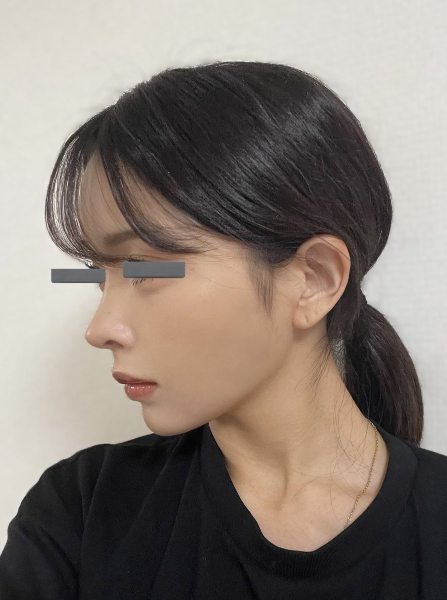 neko84901384's tweet photo. ヒットで鼻整形して6ヶ月🫶🏻
手術してすぐは腫れなどで不安も多かったけど、結果大満足👼🏻
中顔面陥没感が無くなったことによって今までしてきた施術の中でも一番変化を感じられて、本当に満足度が高い👍🏻
後戻りしませんように…！ https://t.co/1DCprksqWw