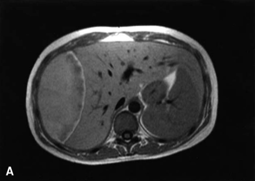 ⚠️ Mujer de 33 años con dolor en el lado derecho del abdomen en su 5° día postparto.

¿Cuál puede ser el diagnóstico? 🤔

#MedX #casoclinico #obstetricia #embarazo #postparto