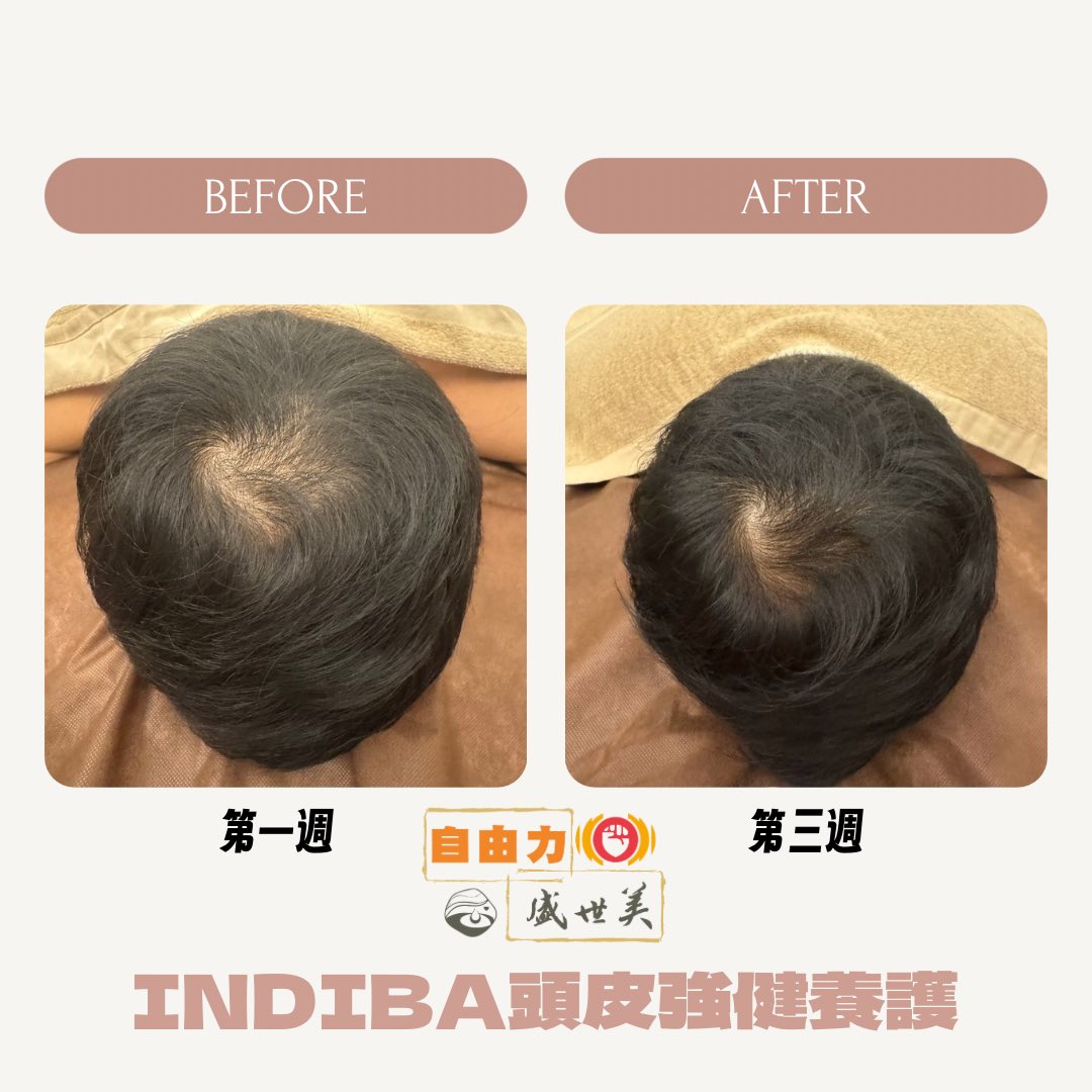 想讓髮絲更豐盈、頭皮更輕盈？INDIBA 原廠頭皮強健養護，打造健康光澤！首次體驗 $1000，再送 紅光賦活，雙重呵護更有感！

線上預約享優惠：
lin.ee/l1zjIm5

✨ 新課程限時優惠 ✨
買 5 堂加送 1 堂，只要 $10xxx
活動至 3 月底，錯過不再！
#頭皮養護 #INDIBA原廠 #科技養護 #紅光護理