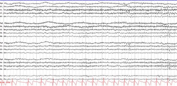 LyellJ's tweet photo. A 24 year old comes in for episodic loss of awareness

1-2 episodes/month, triggered by school stress

All unwitnessed

Diagnosed with epilepsy, modest response to levetiracetam + lamotrigine

Ambulatory EEG (below) + MRI completely normal

Is it time to reconsider the diagnosis? https://t.co/YxIw5gY9hz